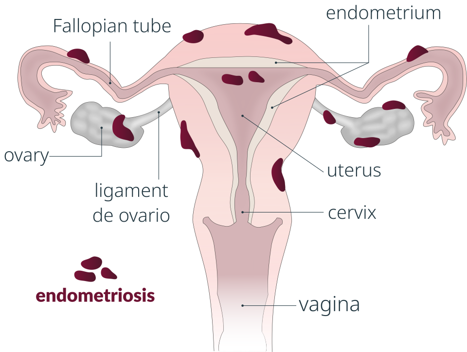 Endometriosis diagram**