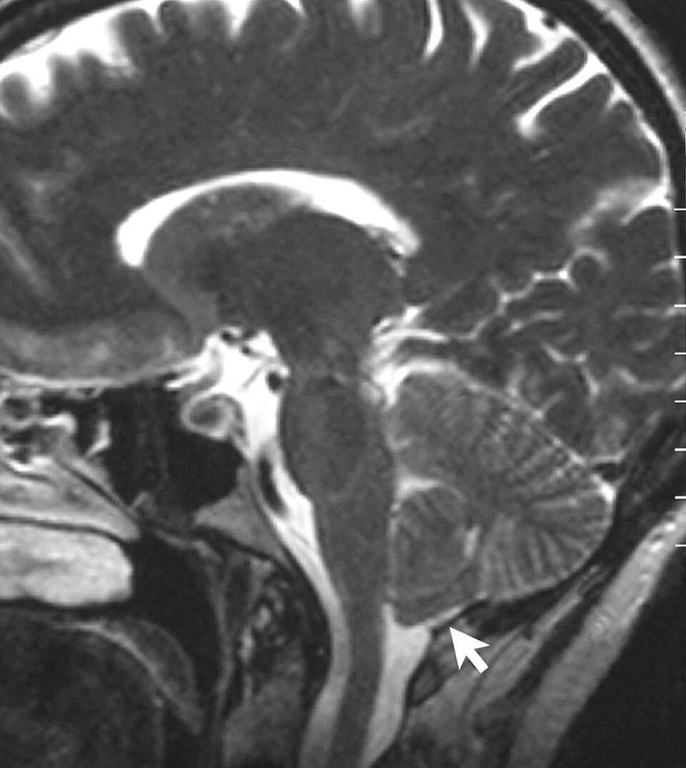 human brain MRI scan**